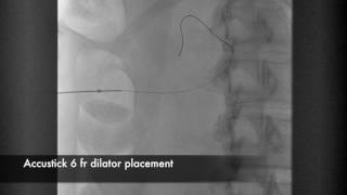 Percutaneous Nephrostomy [upl. by Ardnoet457]