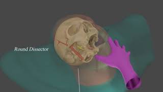 Percutaneous Balloon rhizotomy Animation [upl. by Mikah]