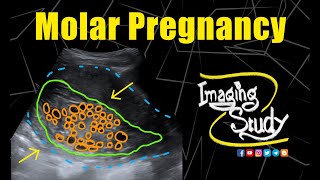 Molar Pregnancy  Hydatidiform Mole  Ultrasound  Case 281 [upl. by Merchant]