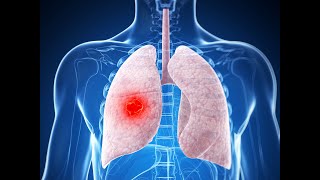 Atezolizumab  CarboplatinEtoposide for ExtensiveStage Small Cell Lung Cancer IMpower133 Update [upl. by Malka]