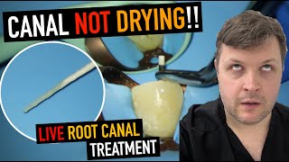 MANAGING NONDRYING CANALS IN RCT  4K resolution [upl. by Feenah]