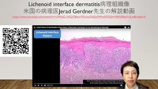 Lichenoid interface dermatitisの病理組織像 [upl. by Hekker]