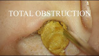 TOTAL OBSTRUCTION  EAR WAX REMOVAL  4KHD [upl. by Imoan]