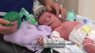 Paediatric Anaesthetics Chapter 4  Extubation neonate [upl. by Doak]