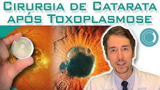 Quem teve toxoplasmose pode operar catarata [upl. by Iznyl]