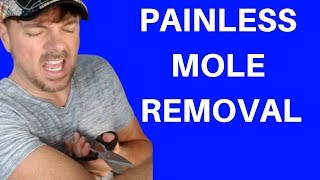 BEST WAY TO REMOVE MOLES  SKIN TAGS TOO  Chris Gibson [upl. by Eveineg793]