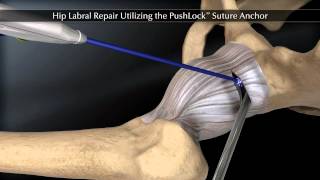 Hip Labral Repair Utilizing the PushLock Suture Anchor [upl. by Notwen639]