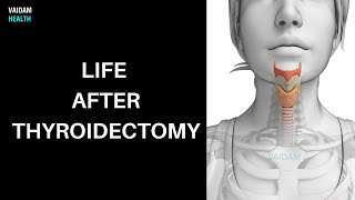 Life after Thyroidectomy [upl. by Medin]