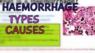 Pathology Lectures Haemorrhage Types and Causes Hemorrhage  EXPLAINED IN 4 MINUTES [upl. by Athal]