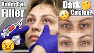 Under Eye Filler Injection for DARK CIRCLES  Alexandra Anele [upl. by Eeryt924]