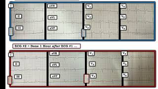 ECG Video Blog 407 — Why Did the Patient Die 12112023 [upl. by Darnall782]