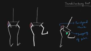 Amputee Trendelenburg Gait  Case Study 27 [upl. by Aurel]