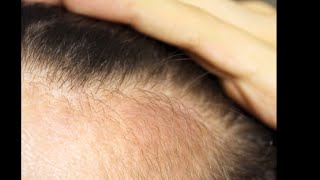 Regrow hair 100 and Stop hair fall Stop hair grey with simple tips [upl. by Sucul]