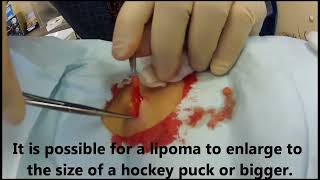 Office Procedure Lipoma Removal [upl. by Tjaden86]