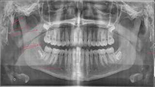 Interprétation de la panoramique dentaire [upl. by Amery]