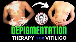 Depigmentation  A Vitiligo treatment which works and is permanent [upl. by Ecirehs268]