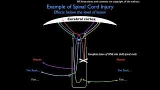 Example Spinal Injury  EFFECTS BELOW THE LEVEL OF LESION [upl. by Sofia]