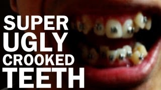 Ugly Crooked Teeth Braces [upl. by Jacinda953]