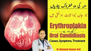 What Is Erythroplakia amp Oral Candidiasis  Causes Symptoms Treatment [upl. by Pace]