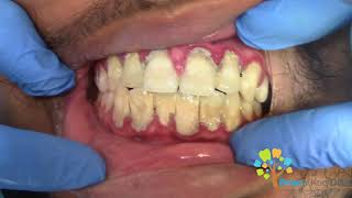 Dental Cleaning to remove heavy tartar🦷 【Young Male first cleaning】 [upl. by Schindler262]