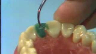 Dental Anatomy Waxing a Maxillary Central Incisor [upl. by Dusza]