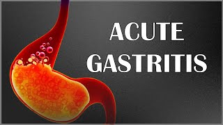 Acute Gastritis  Signs amp Symptoms Causes Pathogenesis Complications Diagnosis amp Treatment [upl. by Erdnaek]