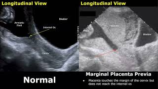 Obstetric Ultrasound Normal Pregnancy Vs Placenta Previa  LowLying Marginal Partial Complete [upl. by Pinckney]