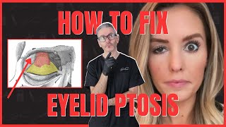 3 Ways to Fix Eyelid Ptosis After Botox [upl. by Cloe992]