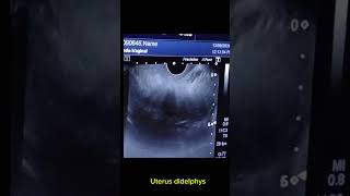 Uterus didelphys with right adnexal haemorrhage cyst [upl. by Eselahc]