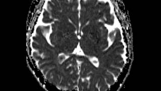 Choroid Plexus Xanthogranuloma [upl. by Stephanie]