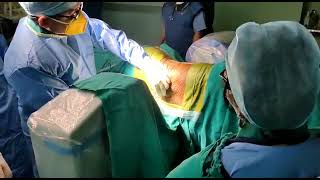 Intrathecal MorphineBaclofen Pump Implantation [upl. by Chor73]