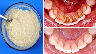 Diese Mischung Auftragen Wird Zahnbelag Entfernen Und Sie Müssen Nicht Zum Zahnarzt Gehen [upl. by Harlie]