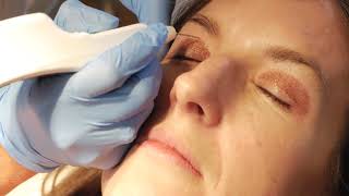 Non surgical blepharoplasty with PLEXR [upl. by Kristen847]