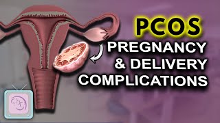 PCOS Pregnancy complications  High risk  Birth Defects [upl. by Okimuk]