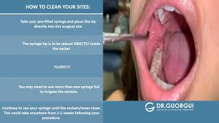 PostOperative Video Irrigation for Extraction and Wisdom Teeth [upl. by Ordnas]