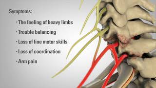 Cervical Laminectomy  Patient Animation [upl. by Ximenez]