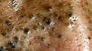 𝐋𝐞𝐚𝐝 𝐀 𝐇𝐚𝐩𝐩𝐲 𝐋𝐢𝐟𝐞𝟗𝟎3  blackheads new this week [upl. by Ayarahs]