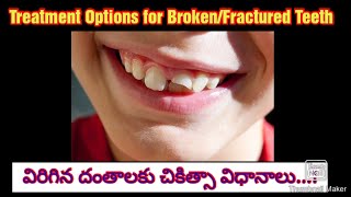 విరిగిన దంతాల చికిత్సా విధానాలు Treatment options for Broken  Fractured teeth drlalithakota6608 [upl. by Bonni]