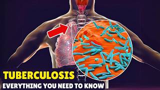 Tuberculosis – Causes Signs and Symptoms Diagnosis amp Treatment [upl. by Lila]