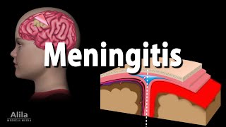 Meningitis Pathology Causes Symptoms Diagnosis and Treatment Animation [upl. by Cahan]