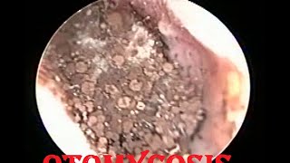 Severe fungal infection  Otomycosis ear cleaning [upl. by Alysa]