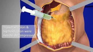 Exploratory Laparotomy  3D Medical Animation  Part  1  Films Blueray [upl. by Nodababus]