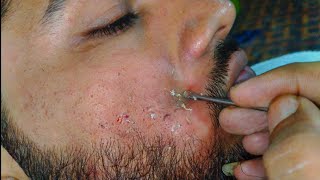 sac be spa blackheads elderly 2024  sac be spa old age blackheads 2024  SS sac be spa thuy 556 [upl. by Htezzil396]