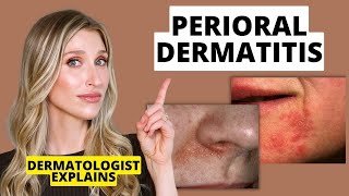 Dermatologist Explains Perioral Dermatitis What it Looks Like Causes amp Treatments  Dr Sam Ellis [upl. by Grenier]