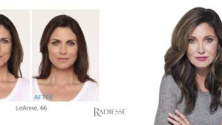 Chernoff Cosmetic Surgeons RADIESSE Wrinkle Filler [upl. by Suiravaj]