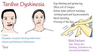 Tardive dyskinesia Causes Symptoms and Treatment [upl. by Gazo887]