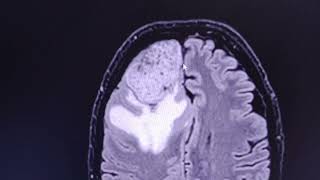 Aggressive meningioma  CT venogram and MRI [upl. by Merat]