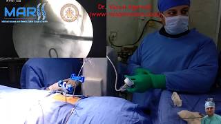 Balloon Kyphoplasty surgical technique by Dr Varun Agarwal wwwmispinecarecom [upl. by Sierra]