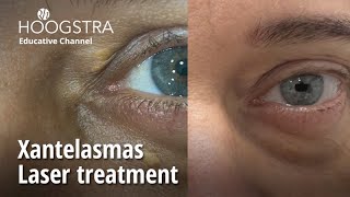 Xantelasmas  Laser treatment  23269 [upl. by Utta]