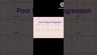 Poor R wave progression Significance of Poor R wave in ECG [upl. by Divadnhoj]